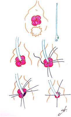 Four vertex technique for correcting urethral prolapse: technique description and cohort study